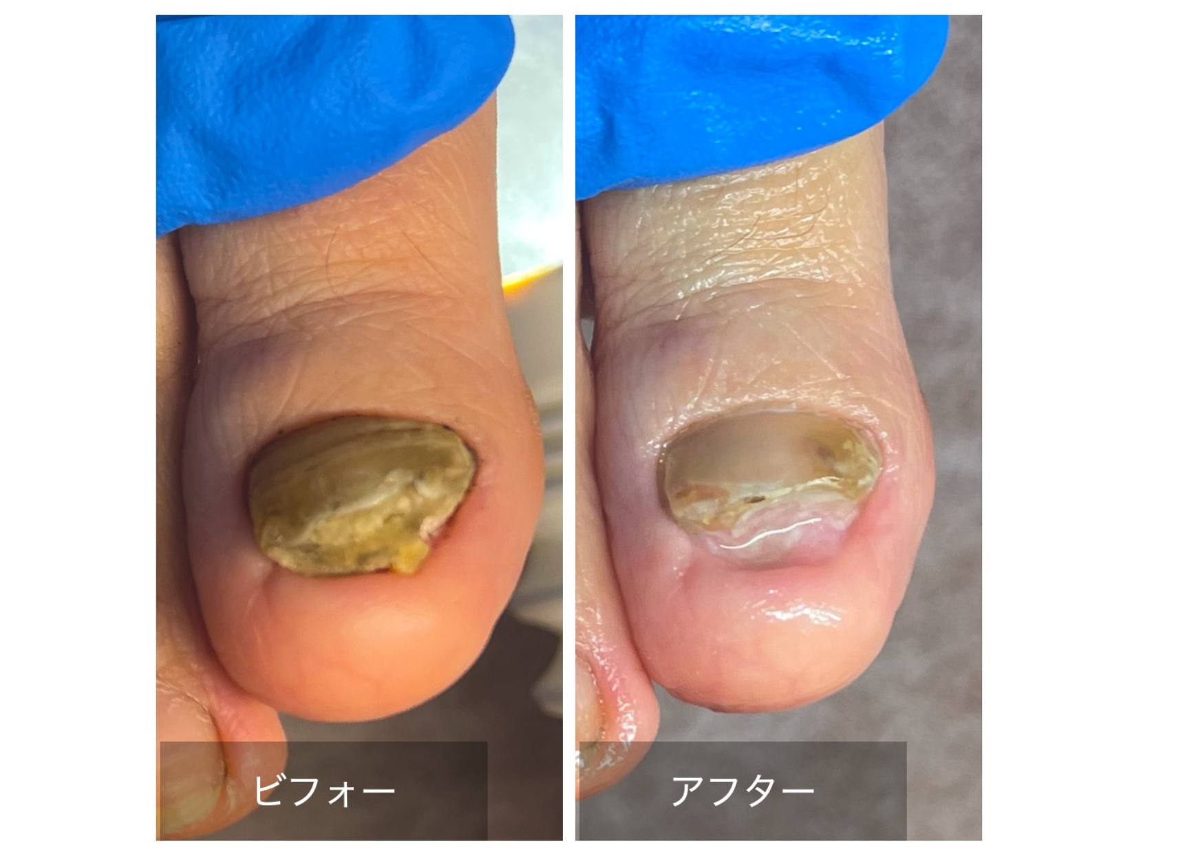 ６０代女性厚くなって切れなくなった変形爪